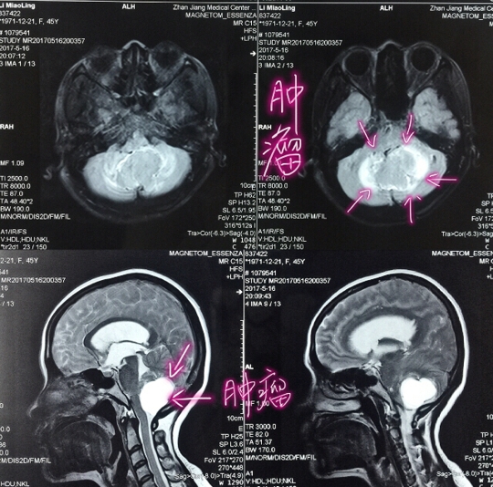 肿瘤占据大部分后颅窝空间
